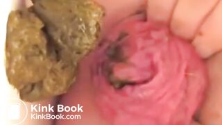 Prolapse Pro (Closeup)