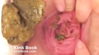 Prolapse Pro (Closeup)