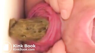 Prolapse Pro (Closeup)