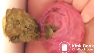 Prolapse Pro (Closeup)