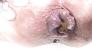 Bloated asshole takes a thick shit