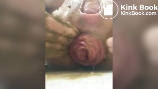 prolapse and shit 39