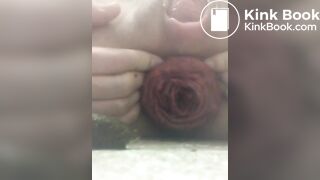 prolapse and shit36