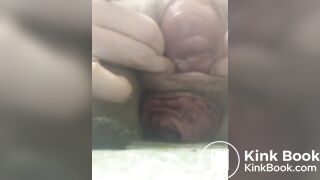 prolapse and shit36