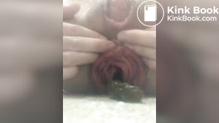 prolapse and shit36