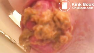 PROLAPSE AND SHIT 34