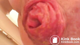 PROLAPSE AND SHIT 34