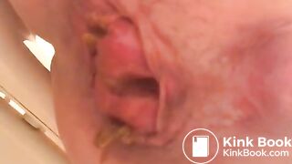 PROLAPSE AND SHIT 34