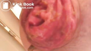 PROLAPSE AND SHIT 34
