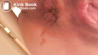 PROLAPSE AND SHIT 34