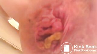 PROLAPSE AND SHIT 34