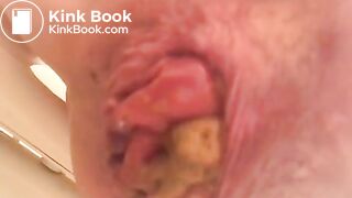 PROLAPSE AND SHIT 34