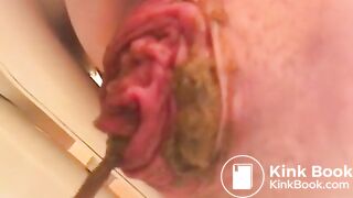 prolapse and shit37