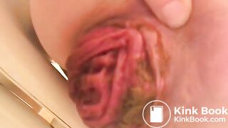 prolapse and shit37