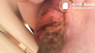 prolapse and shit37