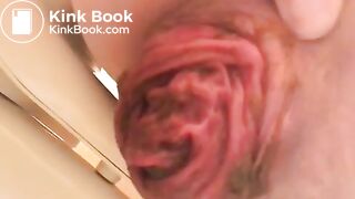 prolapse and shit37