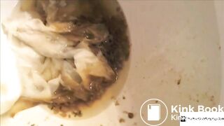 colonoscopy - video 3