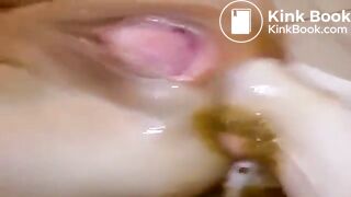 Scat prolapse - video 3