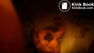 Explosive diarrhea the next morning