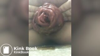 prolapse and shit22