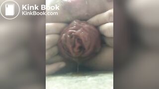 prolapse and shit22