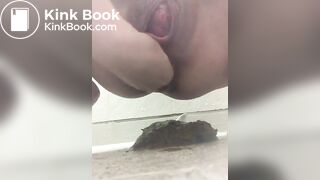 prolapse and shit21