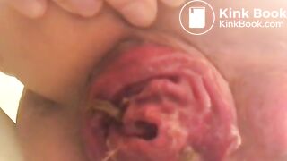 prolapse and shit23