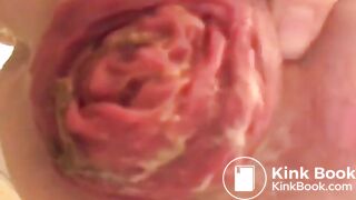 prolapse and shit23