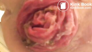 prolapse and shit23
