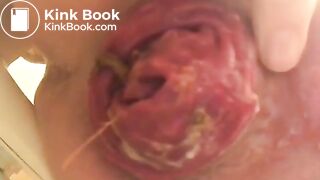 prolapse and shit23