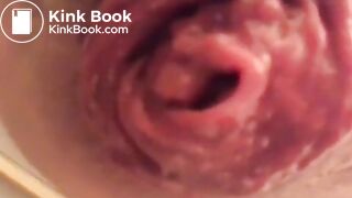 prolapse and shit18