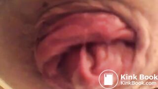 prolapse and shit18