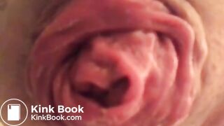 prolapse and shit18
