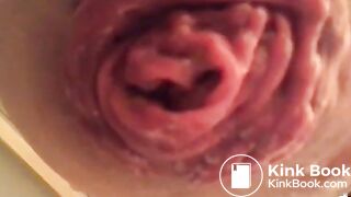 prolapse and shit18