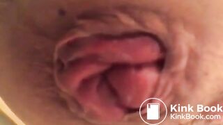 prolapse and shit18