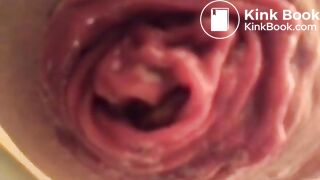 prolapse and shit18