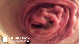 prolapse and shit18
