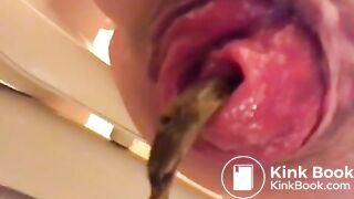 prolapse and shit18