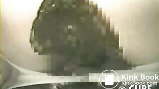 Massive diarrhea in pantyhose