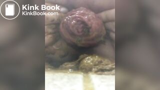 prolapse and shit16