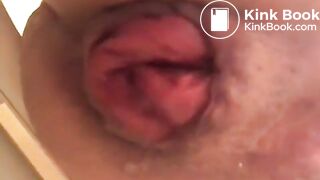 prolapse and shit14