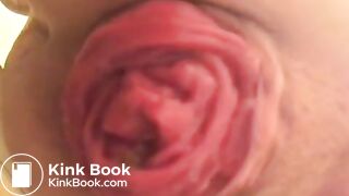 prolapse and shit14