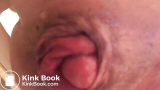 prolapse and shit14