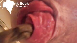 prolapse and shit14
