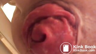 prolapse and shit14