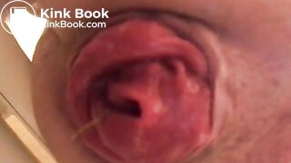 prolapse and shit14