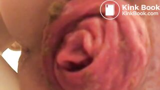 prolapse and shit6