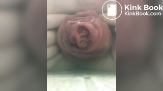 prolapse and shit7