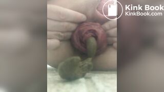 prolapse and shit7