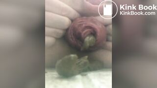 prolapse and shit7